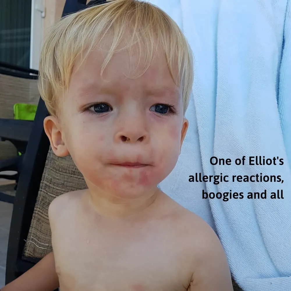 image of allergic reaction on a toddler